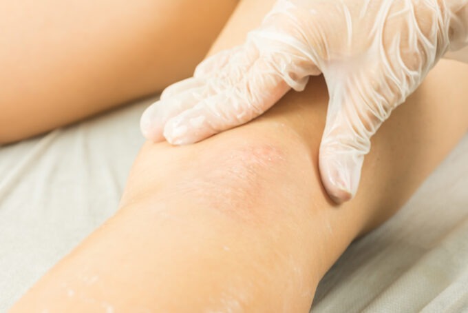 A person undergoing an examination for a scar camouflage treatment at Lisa OM